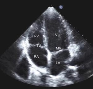 2d-echocardiogram