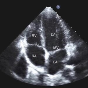 2d-echocardiogram