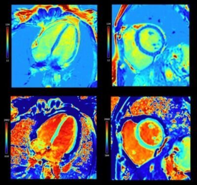 Cardiac MRI 