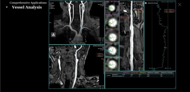 MR Angiography with vessel analysis