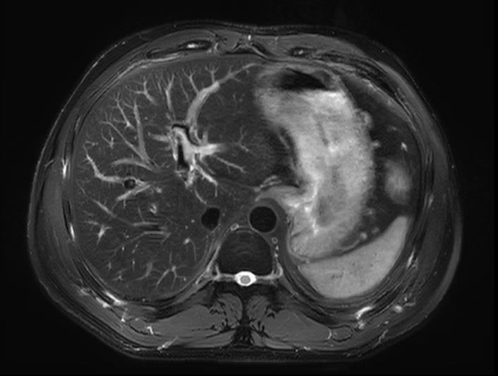 MRI Abdomen