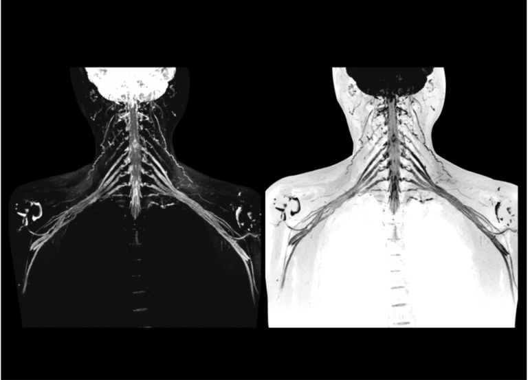 MRI Brachial Plexus 