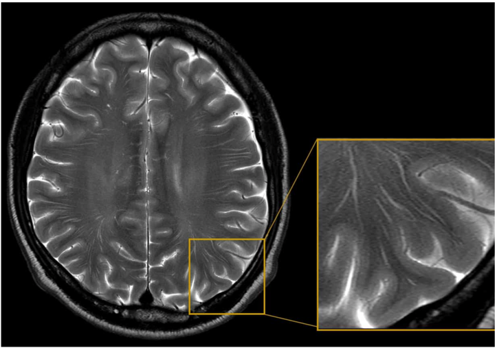 Brain MRI