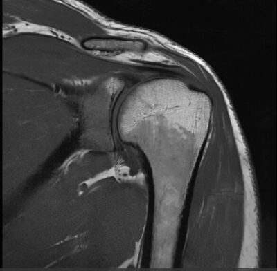 MRI Joints and Musculoskeletal imaging