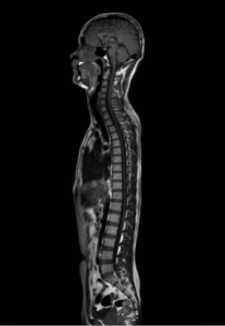 MRI Spine