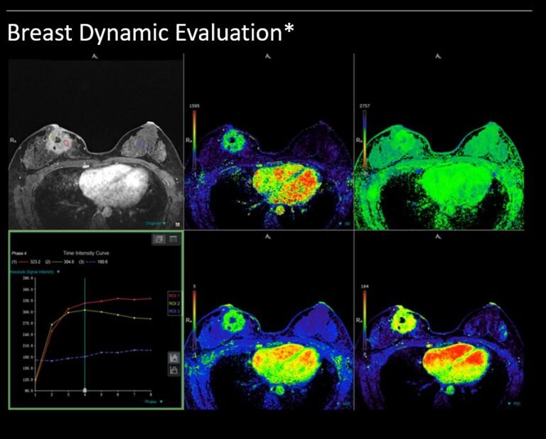 Multiparametric Breast MRI