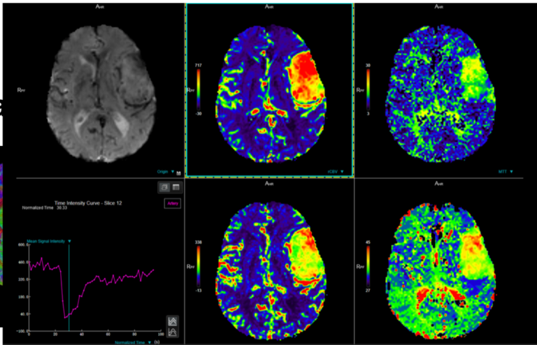 MR Tractography