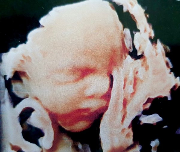 TIFFA (Fetal anomaly scan)