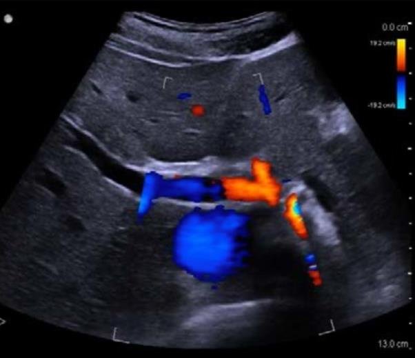 USG Color Doppler Study